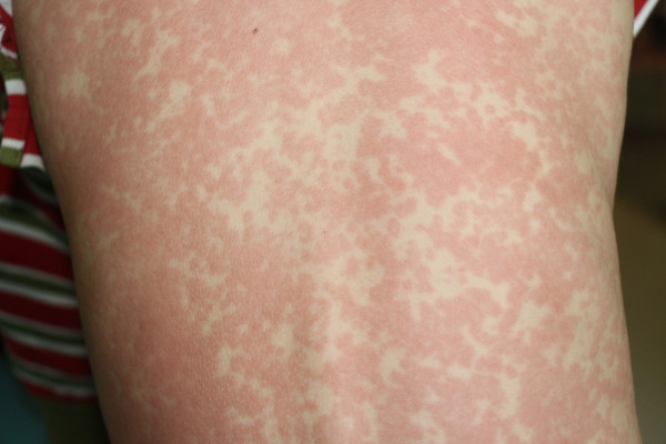 O sarampo pode provocar o surgimento de manchas na pele.