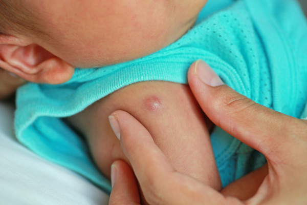 Foto de um recém-nascido, com foco em seu braço, no ponto em que foi vacinado com a BCG.