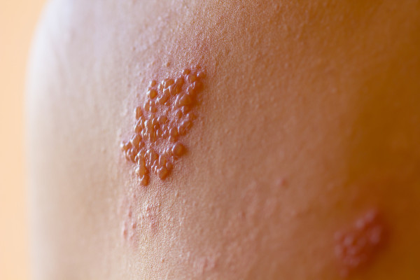 Manifestação de herpes-zóster na pele