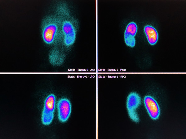 Imagens de rins obtidas por técnicas de medicina nuclear que utilizam o 99mTc.