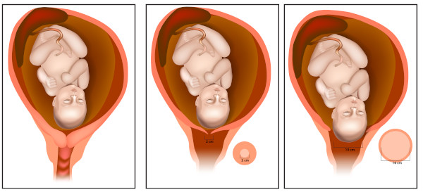  Ilustração da dilatação cervical durante o trabalho de parto.