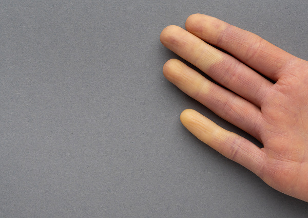 Dedos das mãos em diferentes colorações, ilustrando o fenômeno de Raynaud.