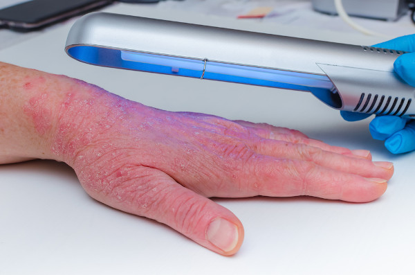 Mão acometida pela psoríase recebendo tratamento fototerápico