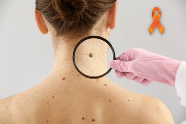 Mitos e verdades sobre o câncer de pele