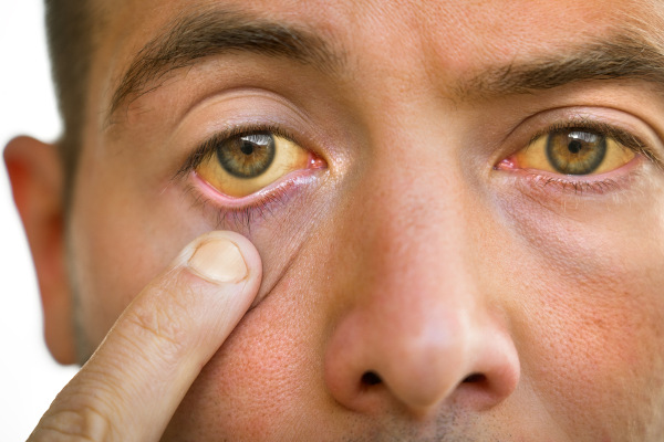 Vista aproximada dos olhos de uma pessoa com icterícia, condição causada pelo excesso de bilirrubina na corrente sanguínea.