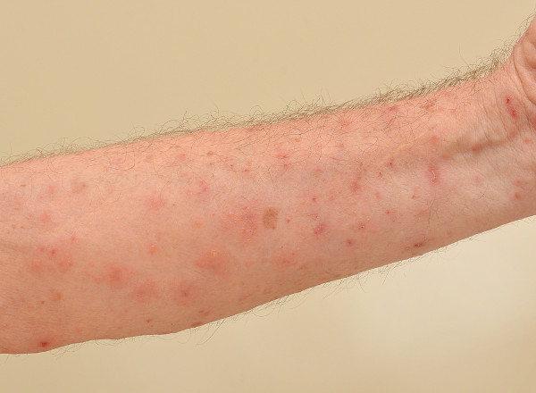 Lesões na pele do braço causadas pela sarna ou escabiose.