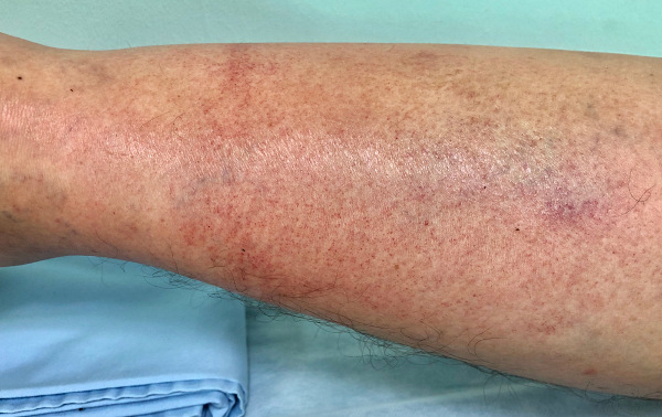 Pele da perna de uma pessoa com lesões causadas pela celulite infecciosa.
