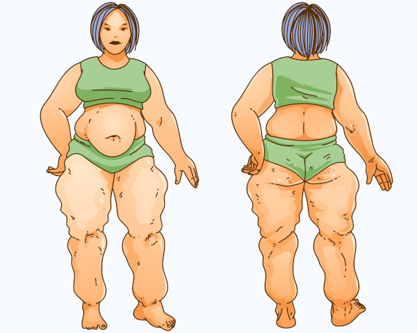 Entenda mais sobre o lipedema, a doença da gordura nas pernas