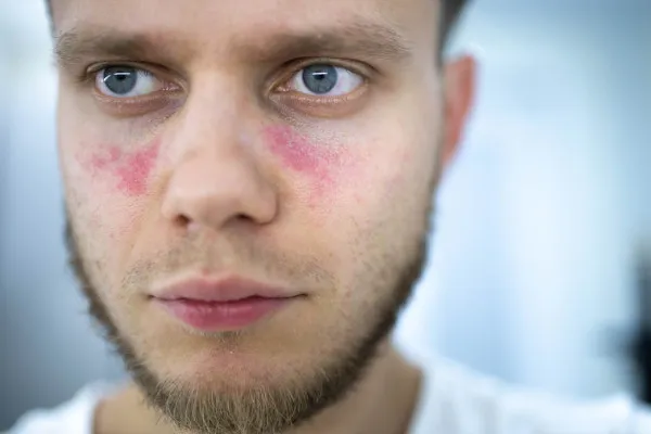 Homem branco com manchas vermelhas no rosto