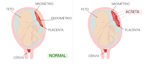 Esquema ilustrativo mostra posição normal da placenta e quando ocorre acretismo placentário.