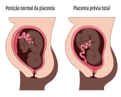 Esquema ilustrativo mostra posição normal da placenta e quando ocorre placenta prévia.