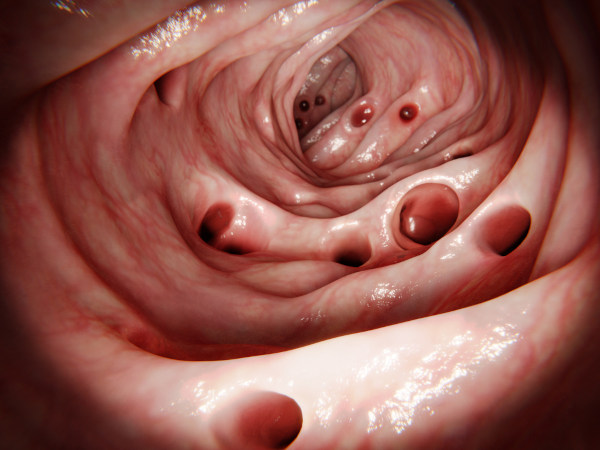 Representação de um intestino grosso com divertículos, cuja inflamação caracteriza a diverticulite.