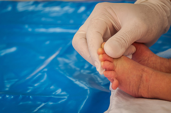 Mão com luva cirúrgica segura pés de bebê com polidactilia, uma das possíveis alterações da síndrome de Patau.