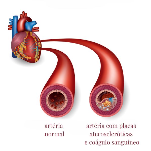 Imagem mostrando a formação de fissuras em placas ateroscleróticas nas artérias, uma das causas da trombose arterial.