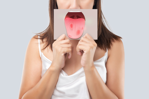 Mulher segurando desenho de uma língua afetada por candidíase oral, doença causada por fungos.