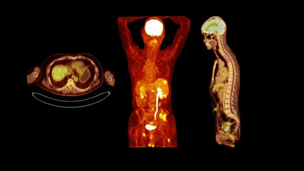 Imagens do corpo humano por meio da tomografia por emissão de pósitrons, uma aplicação da antimatéria.