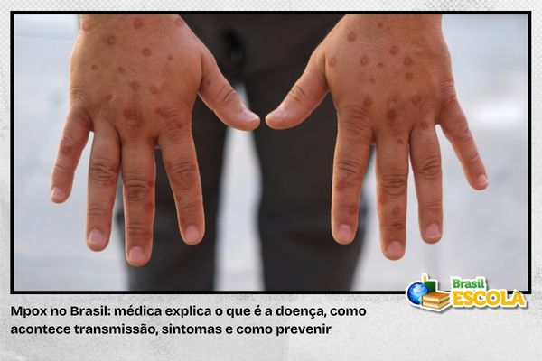 Pessoa com lesões na pele, sintomas da mpox
