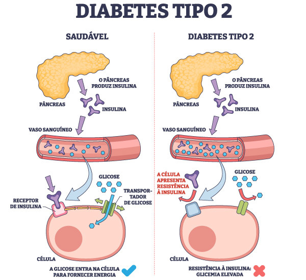 Esquema explicativo do funcionamento da diabetes. 