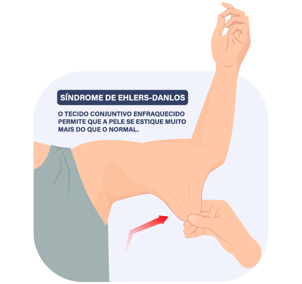 Hiperelasticidade da pele causada pela Síndrome de Ehler-Danlos.