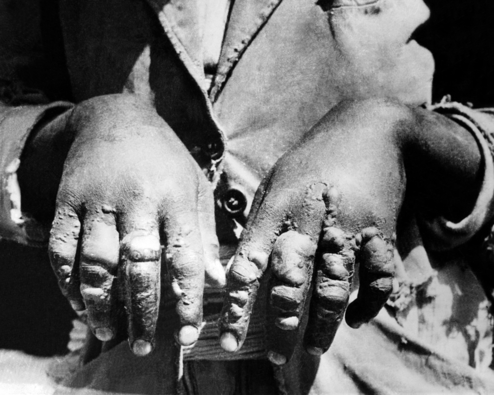Mãos de uma vítima do gás mostarda.