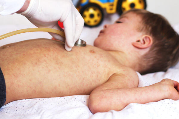 Um dos sintomas do sarampo é o aparecimento de manchas na pele.