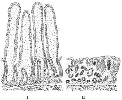 Representação de uma porção do intestino delgado de uma pessoa normal e de uma pessoa com doença celíaca