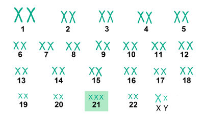 O cariótipo acima mostra a presença de um cromossomo 21 extra