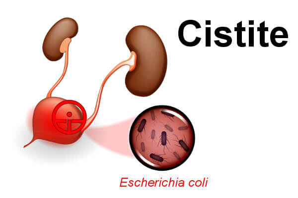Uma das principais bactérias causadoras da cistite é a Escherichia coli. 