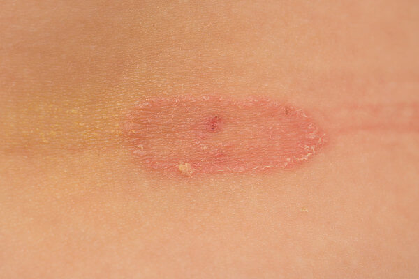 Micoses são doenças causada por fungos e podem gerar, entre outros sintomas, manchas na pele.