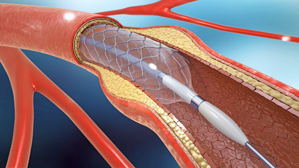 A colocação de stent ajuda a restabelecer o fluxo sanguíneo nas artérias com placas de aterosclerose.